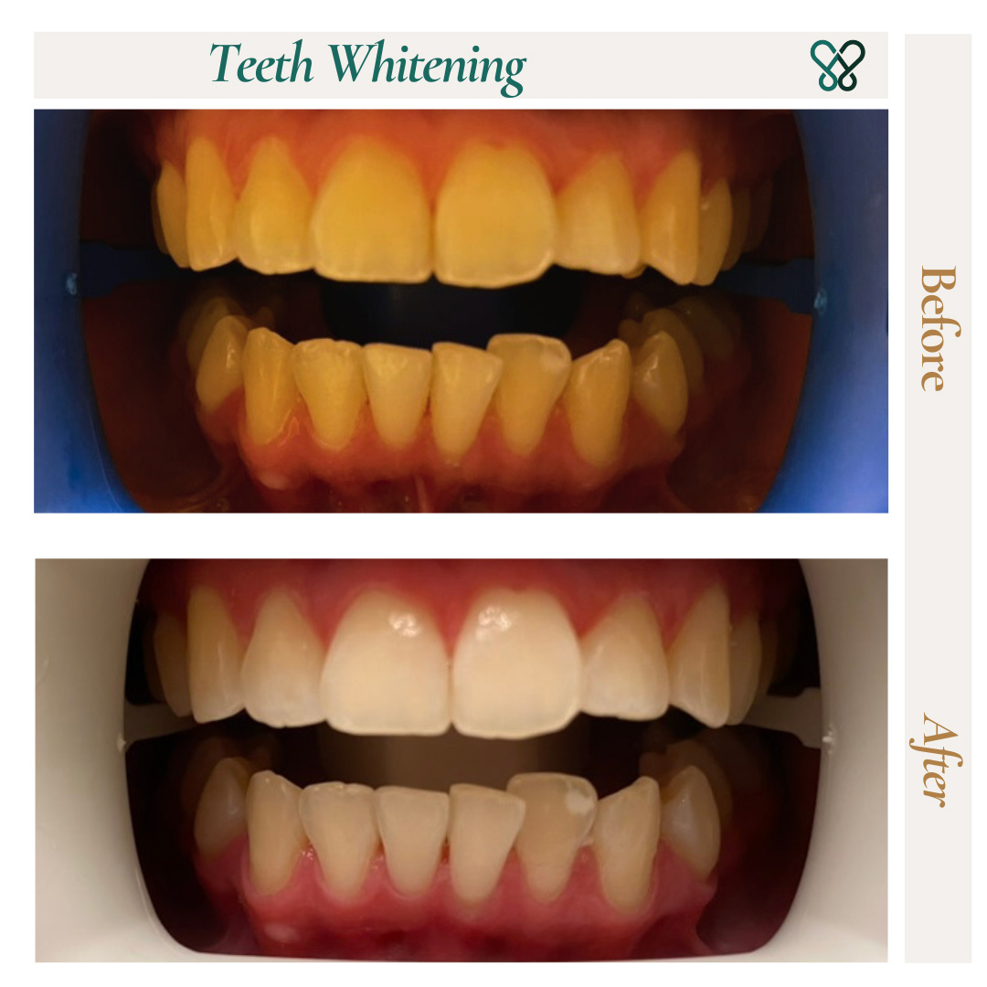 Before and after professional teeth whitening at Avenue Dentistry in Morgan Hill