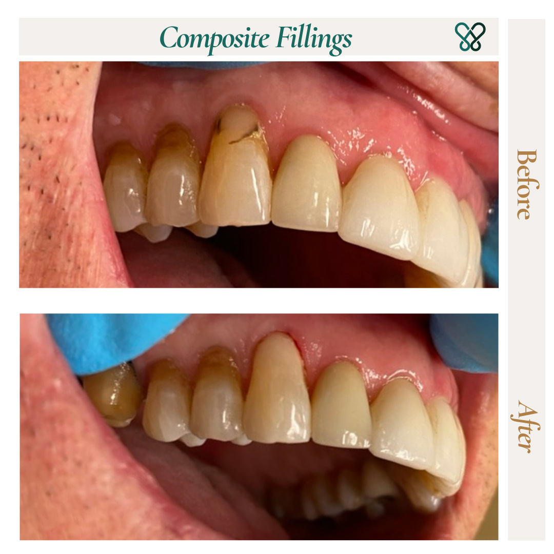 Before and after tooth-colored composite fillings on upper front teeth