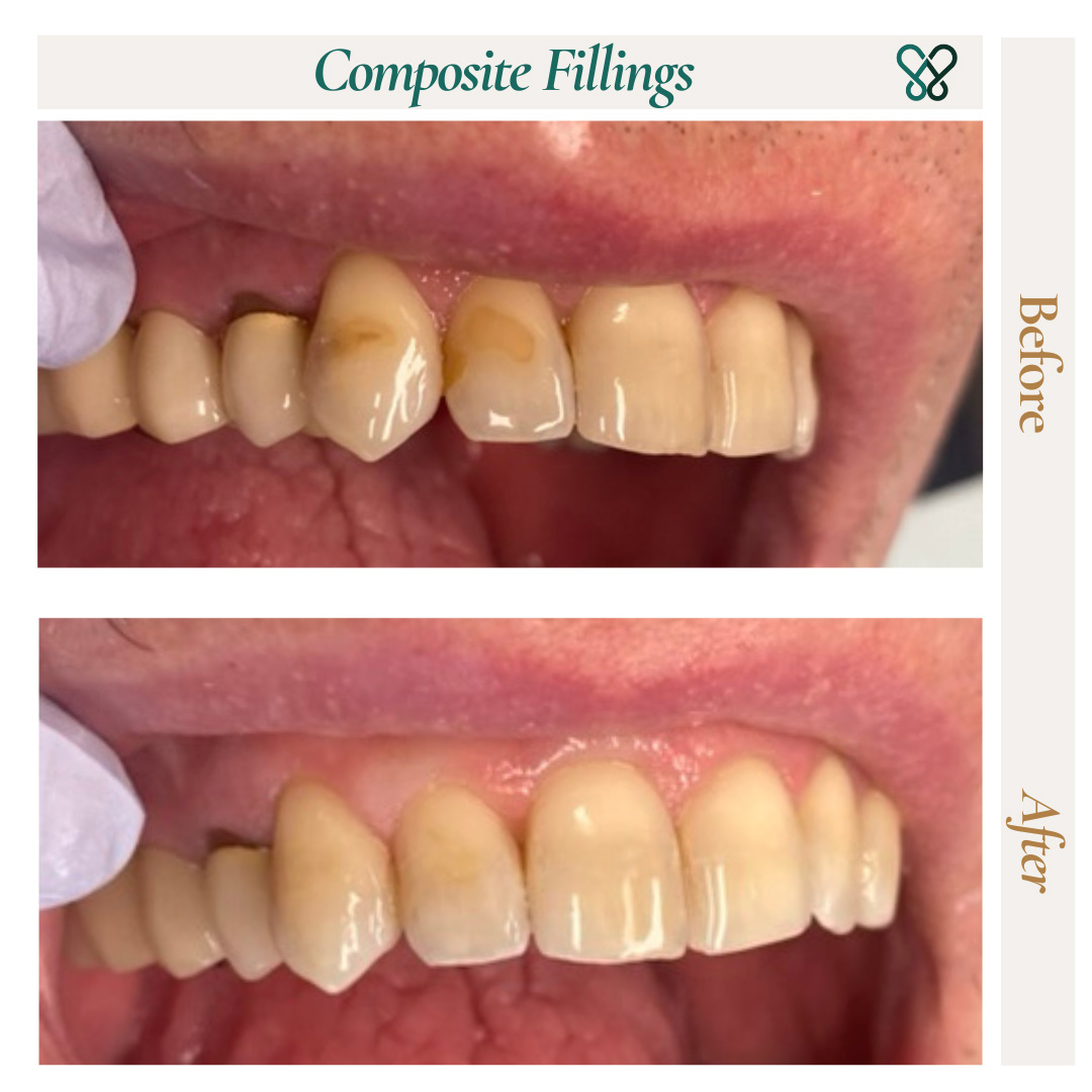 Before and after composite fillings repairing worn upper teeth
