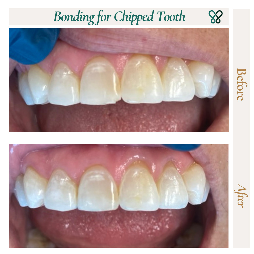 Before and after dental bonding on a chipped front tooth
