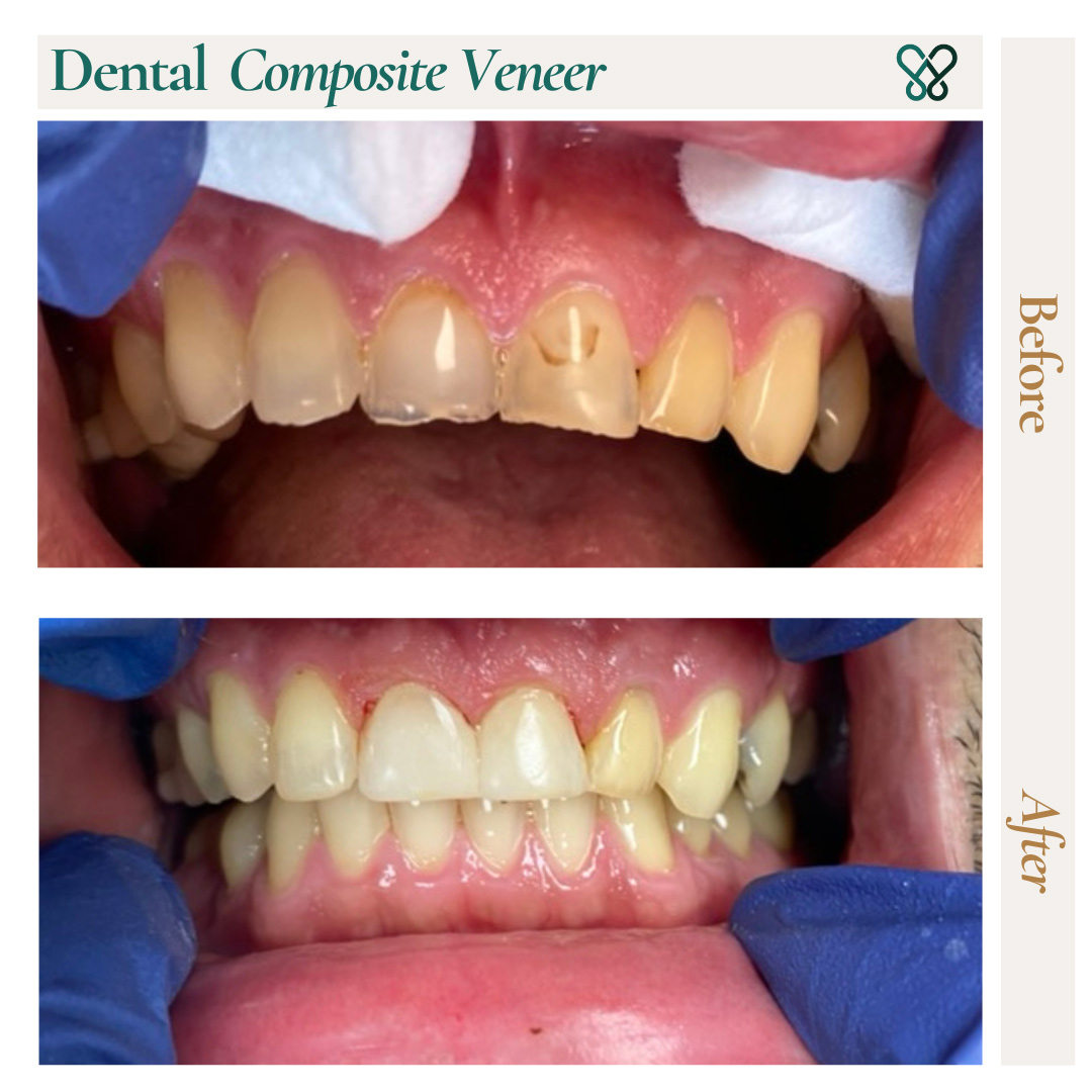 Before and after composite veneers on upper front teeth