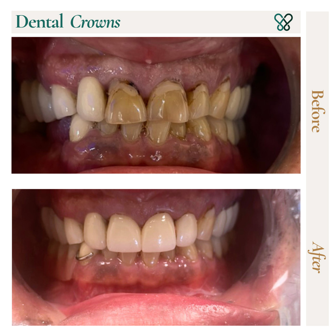 Before and after dental crowns restoring worn and discolored front teeth