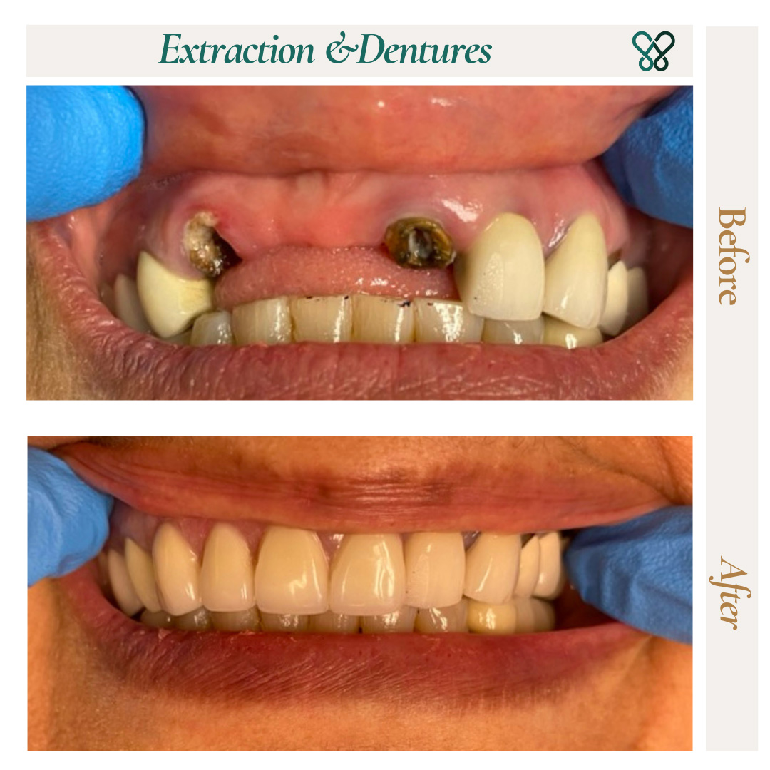Before and after tooth extraction and dentures replacing failing front teeth