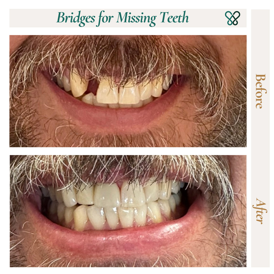Before and after a dental bridge replacing a missing front tooth