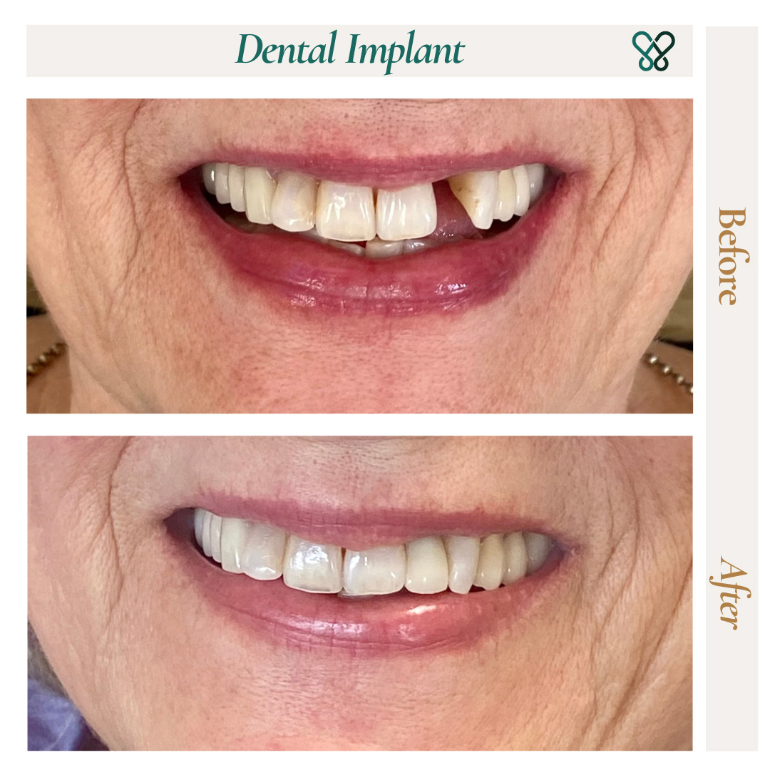 Before and after a dental implant replacing a missing upper tooth