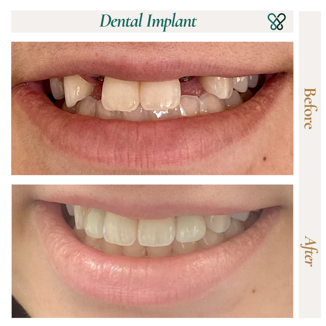 Before and after a dental implant closing a gap in the upper smile